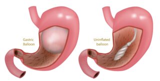 Balon intragastric.