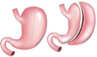 Gastric sleeve
