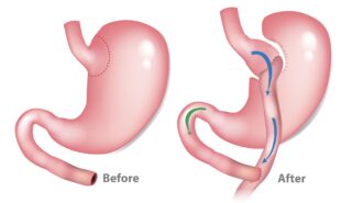 Gastric by-pass.