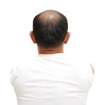 Alopecie