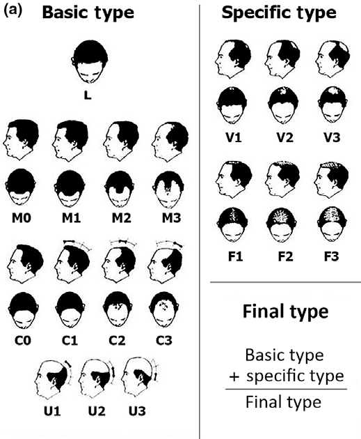 Tipuri de alopecie