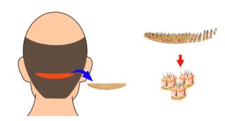 Tratatment chirurgical in alopecie