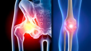 artroza tratamentului genunchiului și șoldului