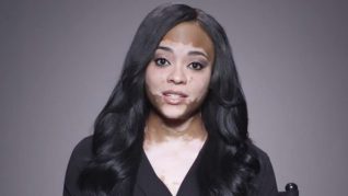 Vitiligo