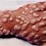 Vaccinare, variola,