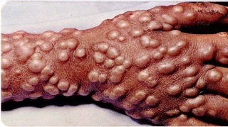 Vaccinare, variola,