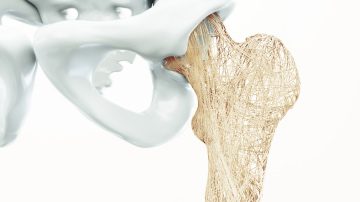 Osteoporoza, Genodynamic,