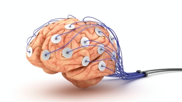 Alzheimer