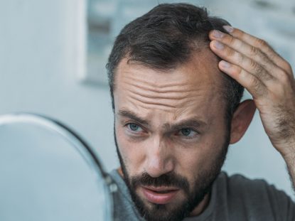 vindecarea alopeciei, Rigenera, celule progenitoare, alopecie,