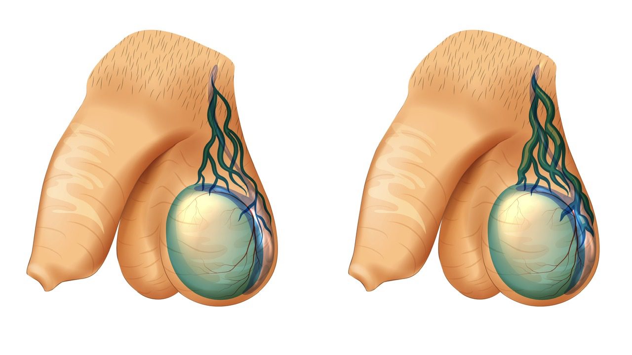 Varicocel