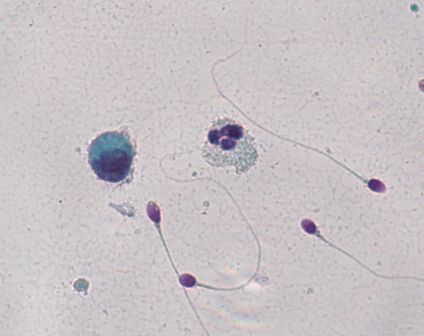 Leucocite si spermii, spermograma, 