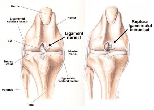 Anatomia genunchiului, ruptura de ligament,