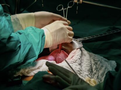 Transplantul hepatic