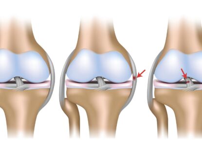 RUPTURA DE LIGAMENT