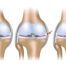 RUPTURA DE LIGAMENT