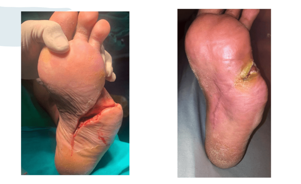 Picior diabetic tratat cu celule progenitorii Rigenera