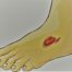 piciorul diabetic, celule mezenchimale, Rigenera,