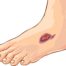 piciorul diabetic, celule mezenchimale, Rigenera,