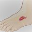 piciorul diabetic, celule mezenchimale, Rigenera,