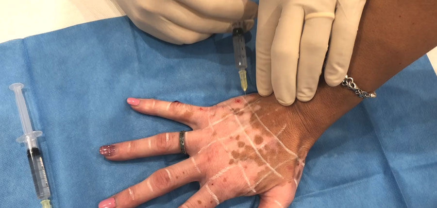 Administrare terapie Rigenera in vitiligo