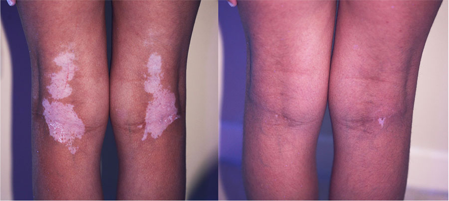 Genunchi vedere posterioara, vitiligo,