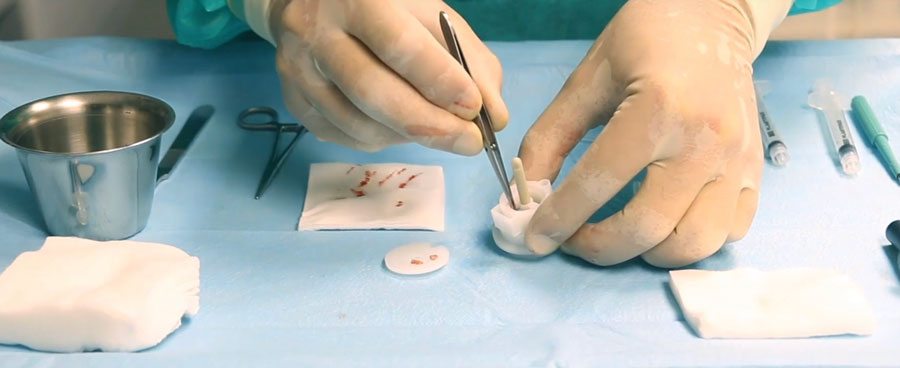 Tesut, microgrefe, piele, Rigenera, vitiligo,