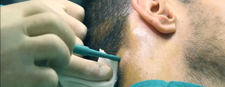 Recoltare, tesut, tratament, vitiligo,