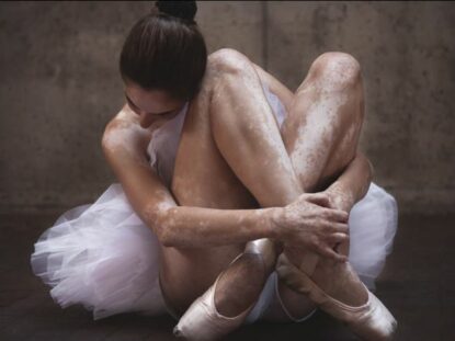 vitiligo, boli de piele, boli autoimune,